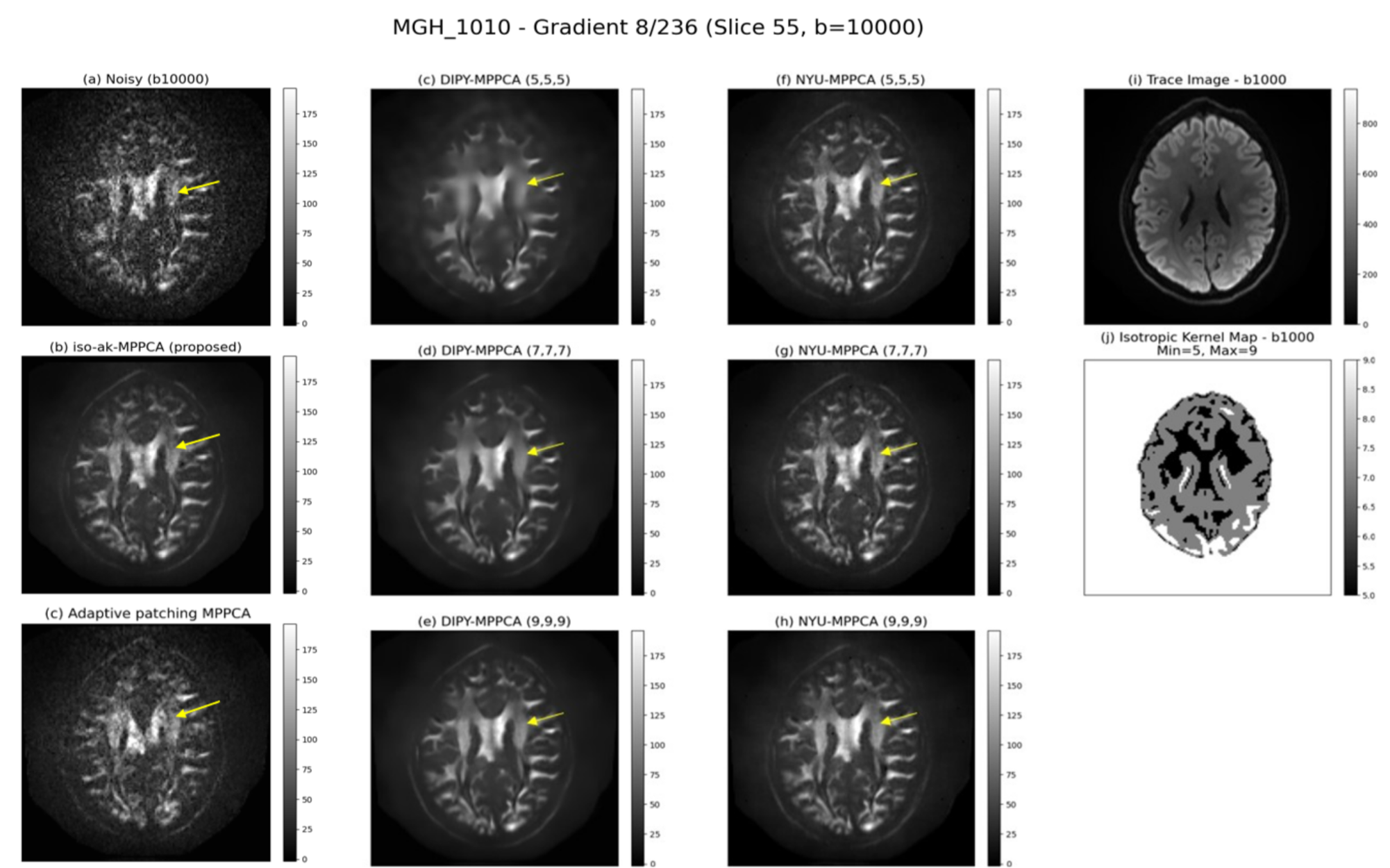 MGH-1010 denoising comparison — b=10000