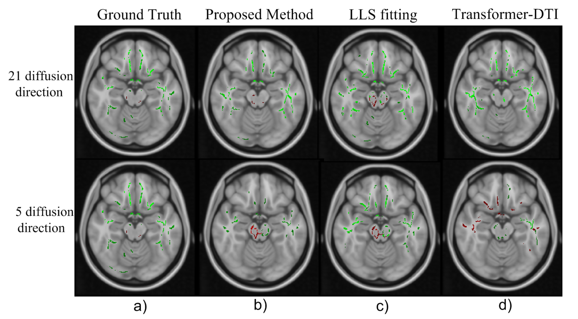 Uncinate Fasciculus TBSS — coronal slice